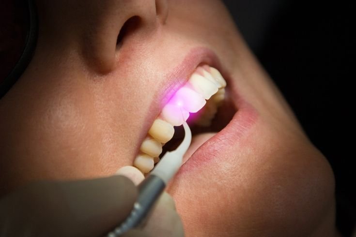 Laser dentistry in Gwalior treatment at Jain Dental Care Centre by Dr. Amit Kumar Jain