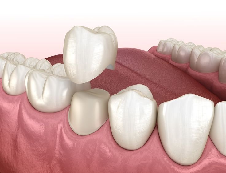Illustration showing dental crown placement - Dental Crowns and Bridges in Gwalior